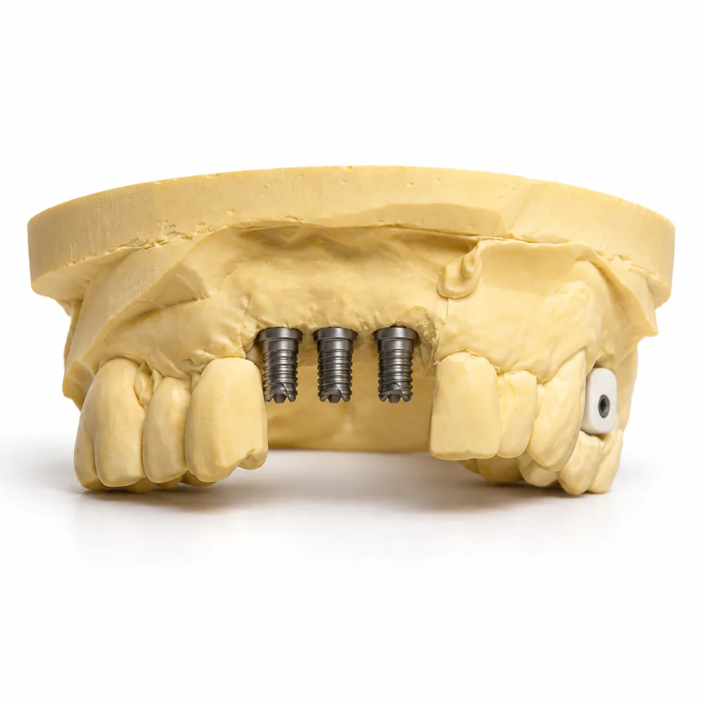 A stone model with three implant analogs where a bridge will sit